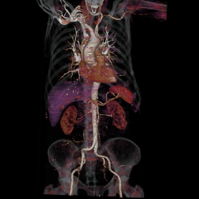 ANGIO TXABDPEL1