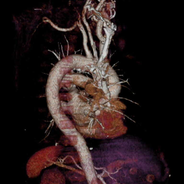 ANGIO TXABDPEL2