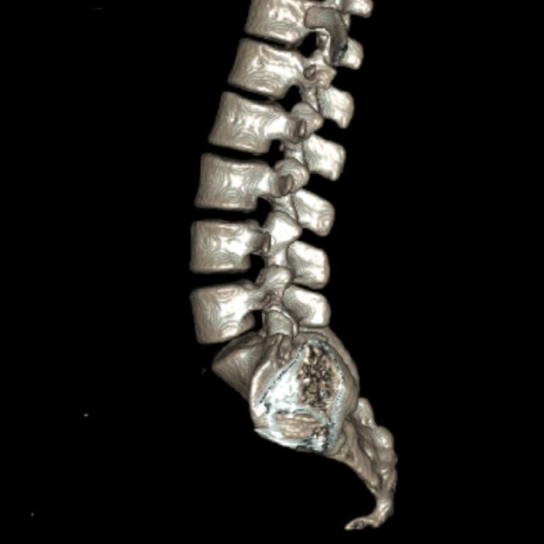 LUMBAR1