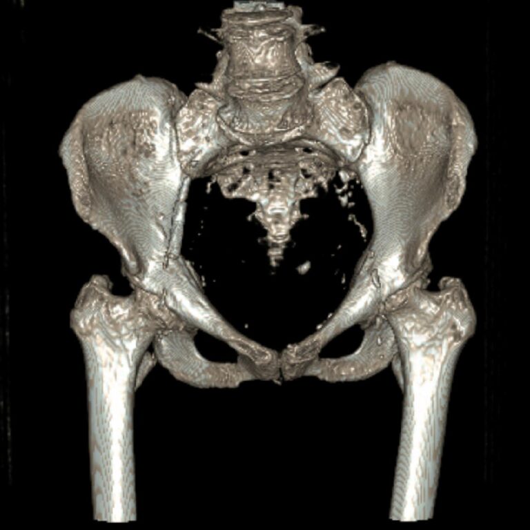PELVIS
