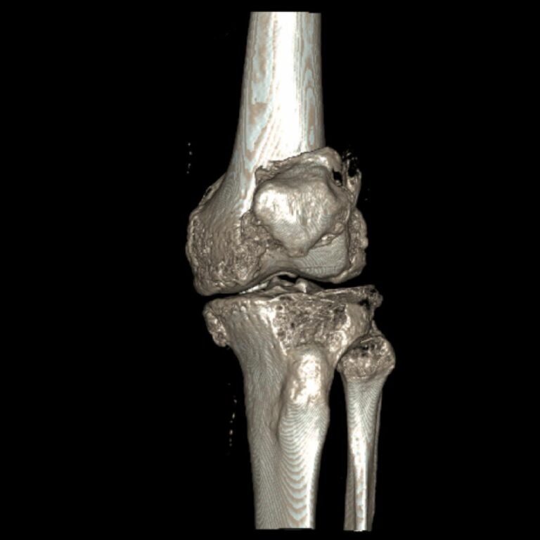 RODILLA