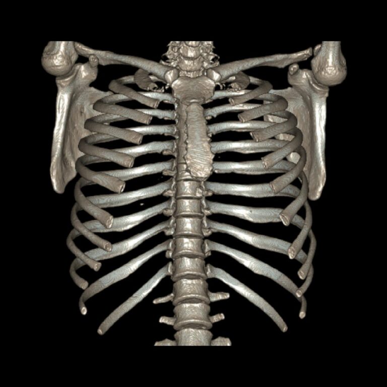 TORAX 1